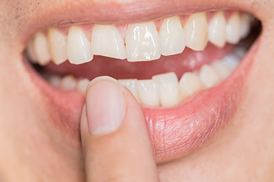 B G Dental | SureSmile reg  Aligners, Night Guards and Extractions