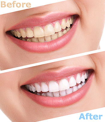 B G Dental | Ceramic Crowns, Implant Dentistry and Dental Fillings