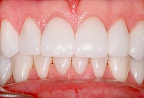 B G Dental | Implant Dentistry, Extractions and All-on-6