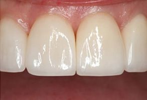B G Dental | Invisalign reg , All-on-6 and Digital Impressions