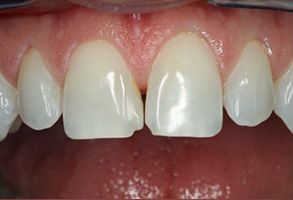 B G Dental | SureSmile reg  Aligners, Ceramic Crowns and Invisalign reg